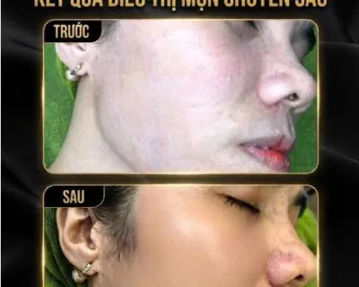 Trị Mụn Tại An Phước – Chăm Sóc Da Chuyên Sâu Tại Trang Vy Spa