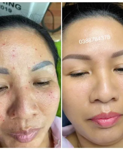 Trị Mụn