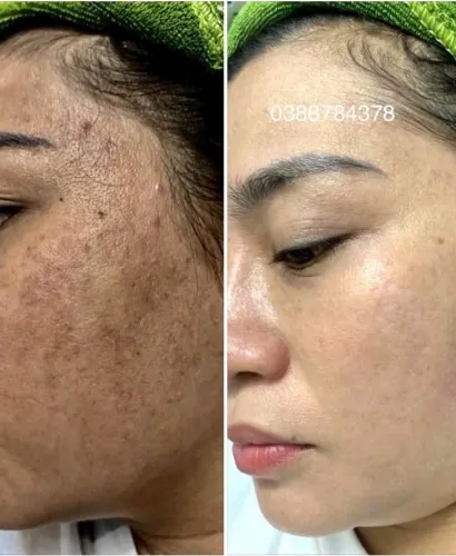 Trị Nám