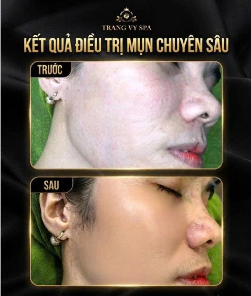 Trị Mụn Tại An Phước – Chăm Sóc Da Chuyên Sâu Tại Trang Vy Spa